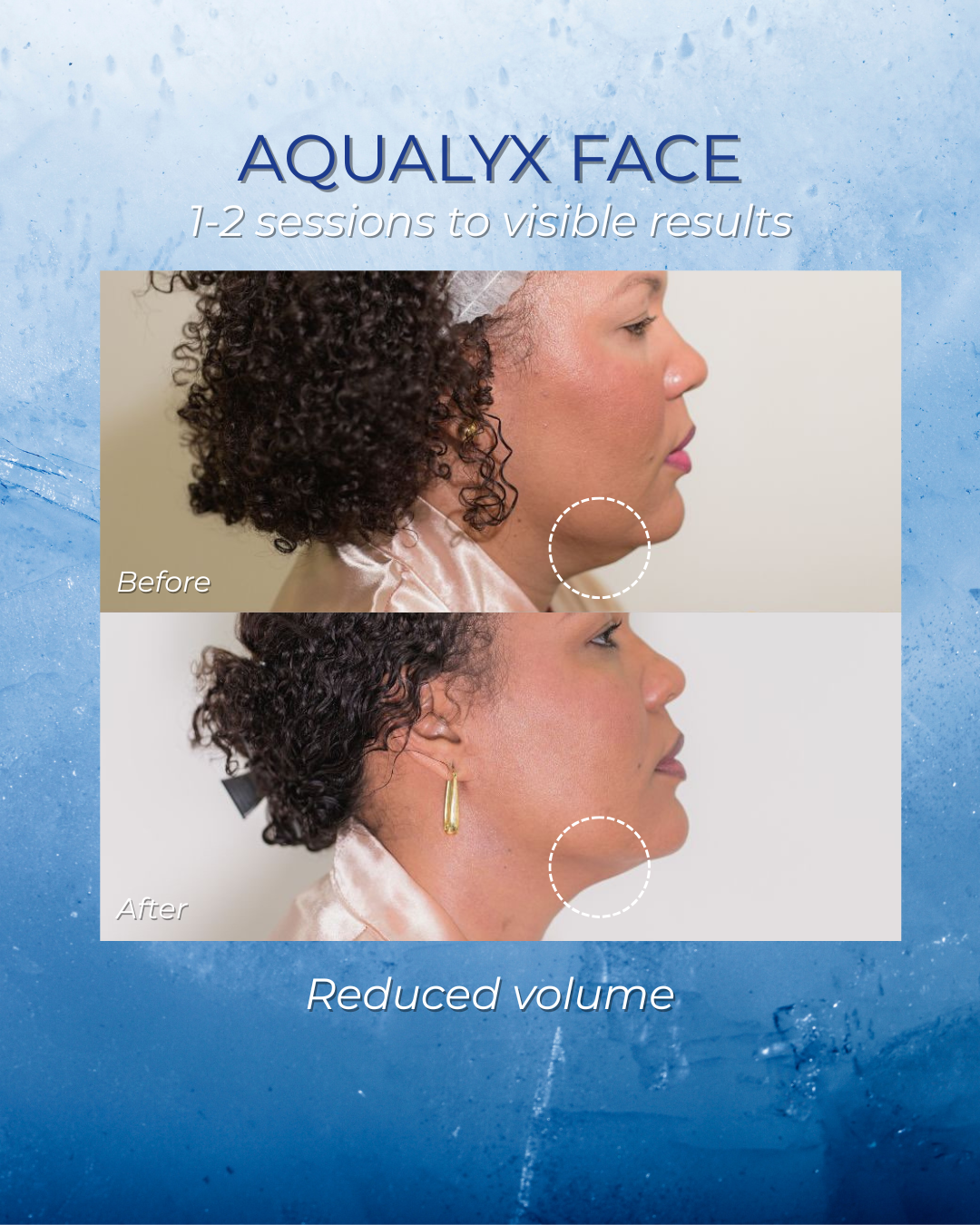 Aqualyx Face Kit results