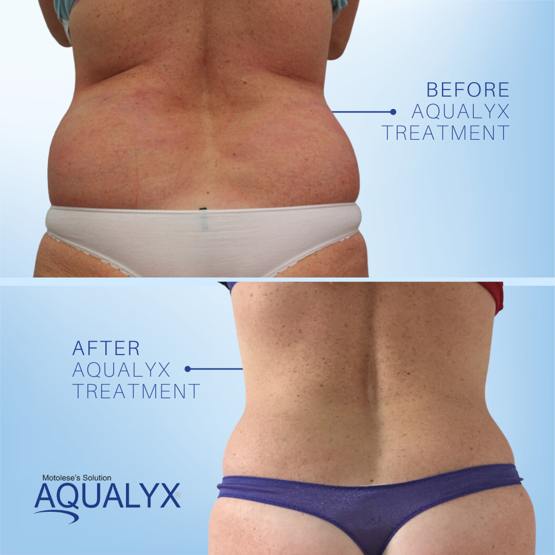 Aqualyx results